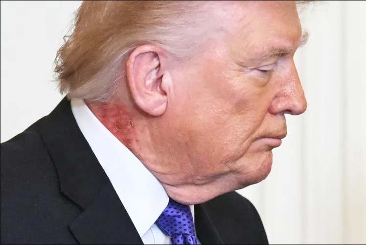 Donald Trump, Trump neck rash, Donald Trump health, Trump scabbing neck rash, Trump Medal of Honor ceremony, Donald Trump appearance, Trump health concerns, Trump latest news, Donald Trump 79 years old, Trump public appearance, Trump neck injury, Trump rash photos, Trump news today, Medal of Honor ceremony Trump, Trump viral photos, Trump controversy, Donald Trump updates, Trump Washington event, Trump skin rash speculation, Trump trending news 🇺🇸📸
